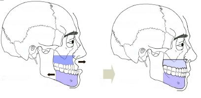 bi-maxillary osteotomy
