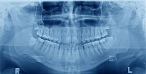 Panoramic x-ray image of teeth. Problem with wisdom tooth.